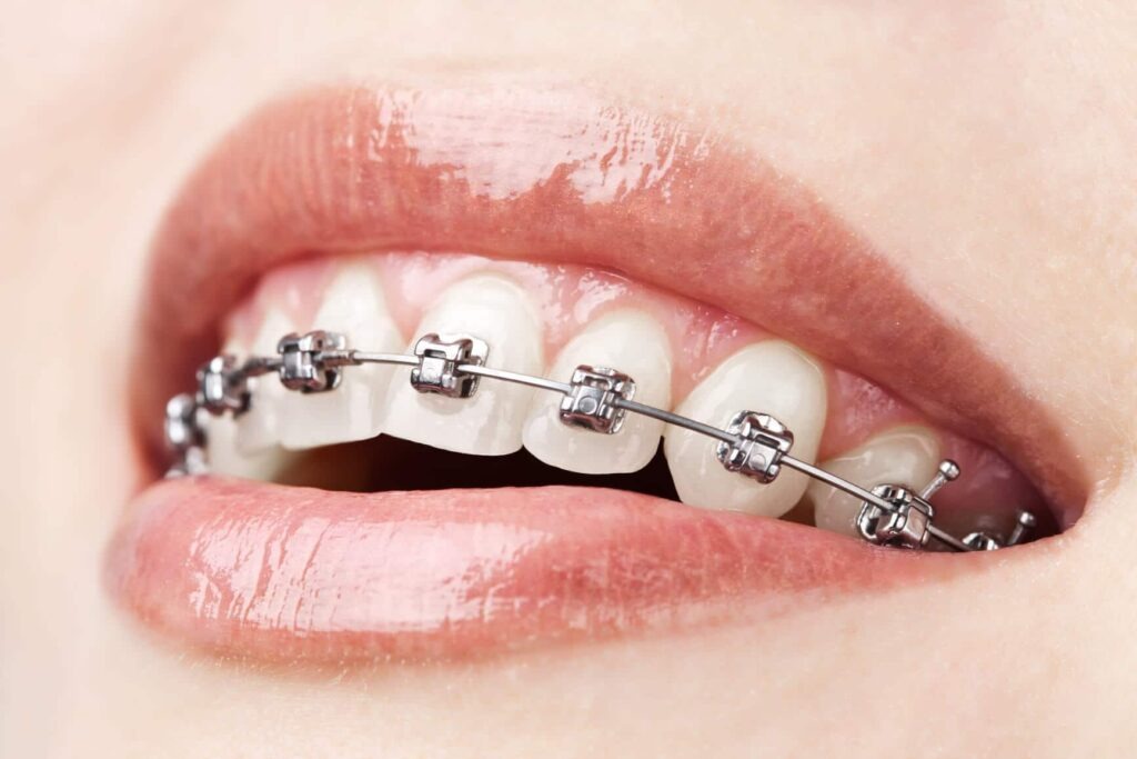 Orthodontic Braces
